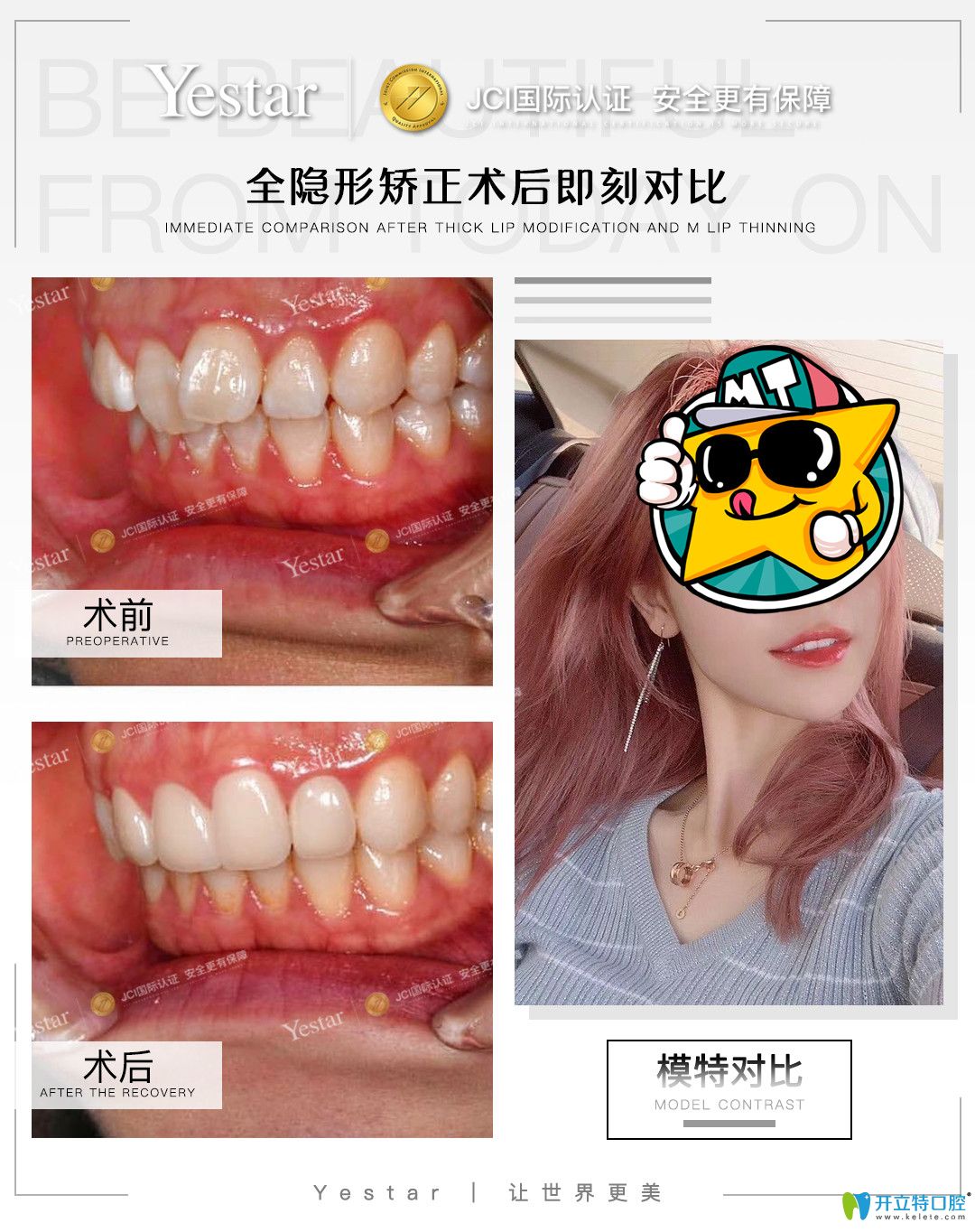 藝星口腔牙齒矯正前后的真人案例