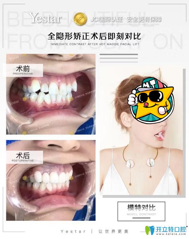 藝星口腔時代天使隱形矯正不齊牙齒<span style=