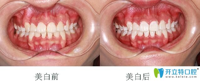 在深圳格倫菲爾口腔矯正后做牙齒美白 在深圳格倫菲爾口腔矯正后做牙齒美白