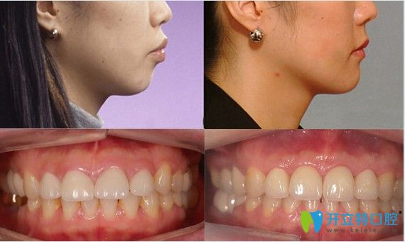 齙牙矯正， 隱形矯正16個月效果圖