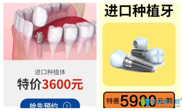 正夫口腔其他種植體價格圖