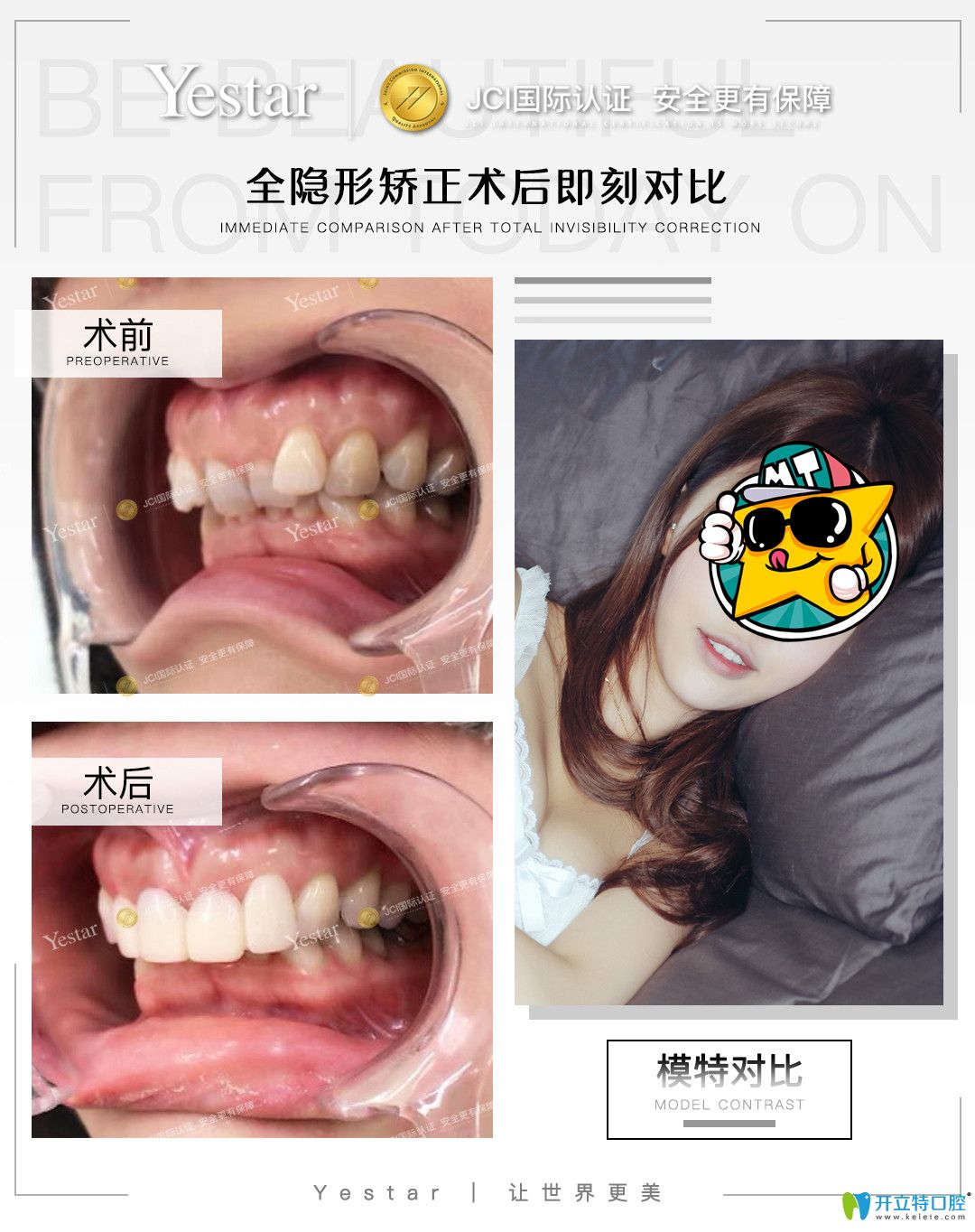 在寧波藝星口腔戴隱形牙套是什么感受，真實(shí)正畸經(jīng)驗(yàn)分享