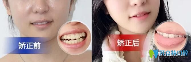 不了解深圳下沙韋博口腔怎么樣可參考韋博牙齒矯正日記