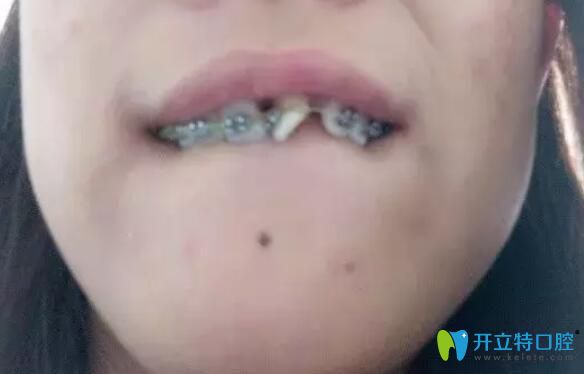 在寧波牙博士初戴鋼絲牙套矯正牙齒