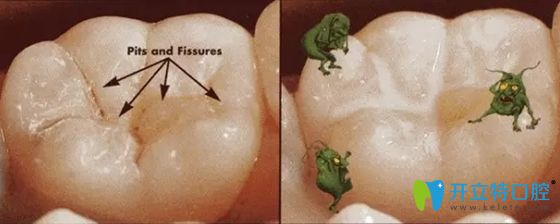 窩溝封閉劑固化后無毒無害