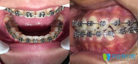 在深圳韋博口腔做牙齒矯正一年效果圖 在深圳韋博口腔做牙齒矯正一年效果圖