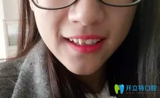 矯正多生牙對比圖來啦，在寧波牙博士做鋼絲矯正效果不賴