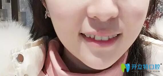 在深圳韋博口腔做牙齒矯正6個(gè)月