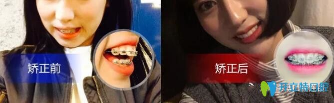 深圳韋博牙齒前突小姐姐矯正牙齒送“下巴”