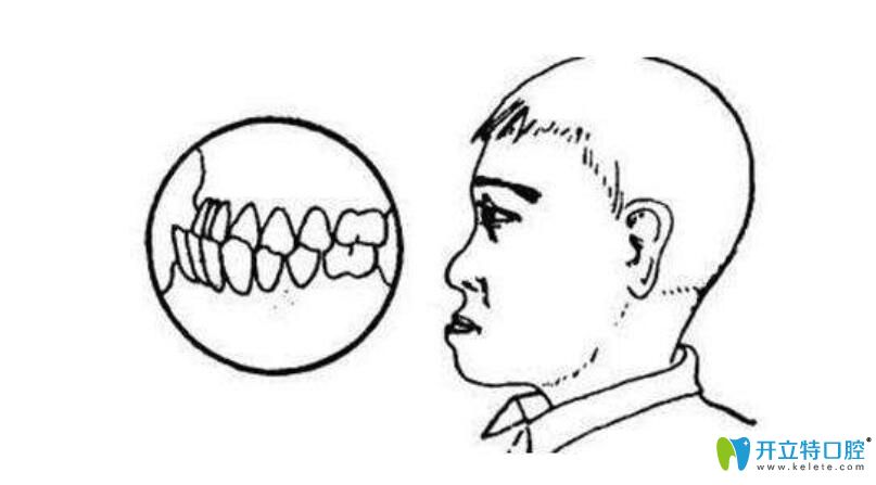 牙齒反合=地包天？如果不幸遭遇牙齒反合是不是一定要矯正