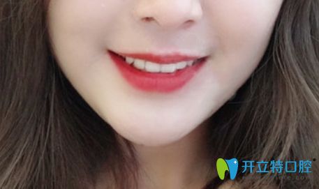 花2萬多元在珠海九龍口腔做的隱形矯正效果 花2萬多元在珠海九龍口腔做的隱形矯正效果