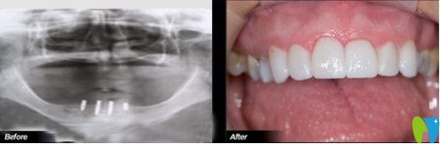 何先生做過(guò)種植牙的案列圖