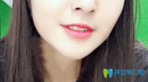 我在珠海九龍口腔做的隱形矯正價格是2萬元起 我在珠海九龍口腔做的隱形矯正價格是2萬元起