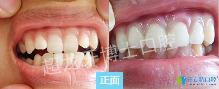 超龍牙博士口腔牙齒擁擠前凸矯正案例圖