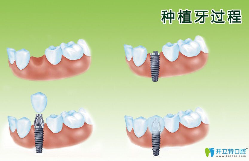 種植牙過程圖