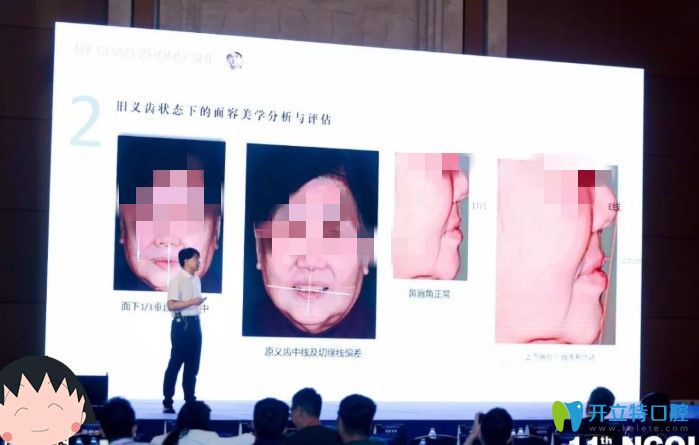 北京維樂(lè)口腔時(shí)紹忠美學(xué)修復(fù)講解圖