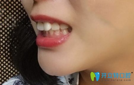 珠海牙齒矯正價格參差不齊,我在九龍口腔做隱形矯正是2萬起