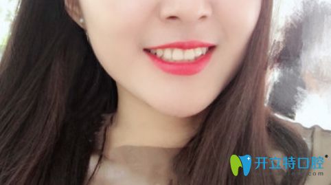 我戴隱形牙套一年效果圖 我戴隱形牙套一年效果圖