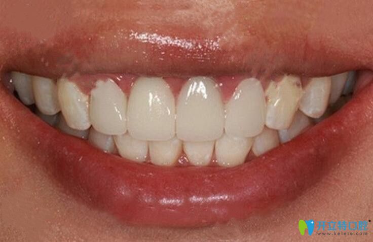 珠海九龍口腔陳軍即刻種植牙效果圖 珠海九龍口腔陳軍即刻種植牙效果圖