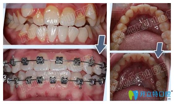 虎牙矯正半年后的牙齒情況