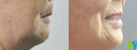 趙阿姨在尚愛韓美做全口種植牙前后對(duì)比圖