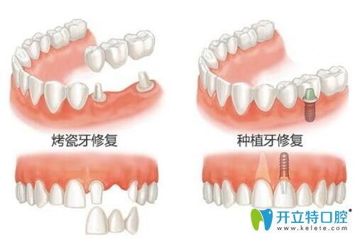 珠海仁愛口腔何維森醫(yī)生分享種植牙和烤瓷牙的區(qū)別