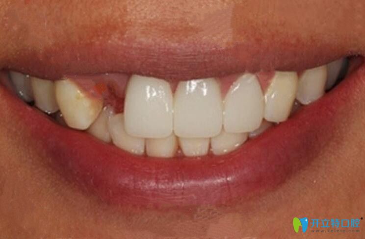 去珠海九龍口腔做即刻種植牙前 去珠海九龍口腔做即刻種植牙前