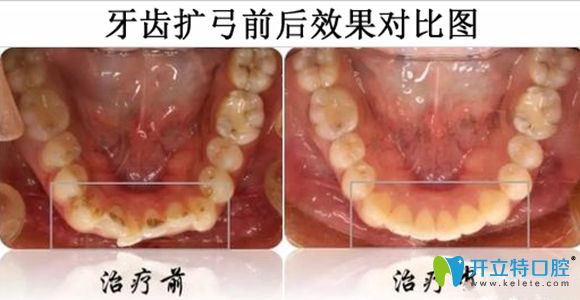 牙齒擴(kuò)弓前后效果對(duì)比圖