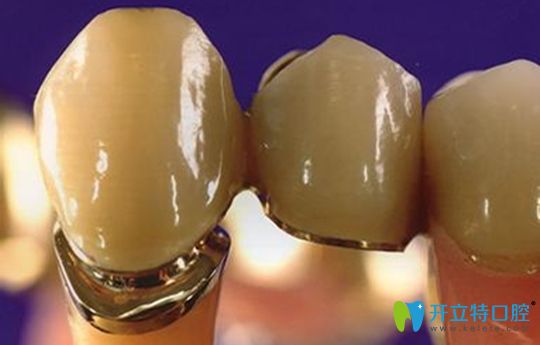 聽(tīng)說(shuō)你在問(wèn):鈀金烤瓷牙多少錢(qián)1顆,鈀金牙和全瓷牙選哪個(gè)好
