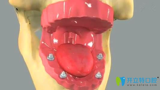 北京瑞鯊口腔靳迎軍醫(yī)生即刻負(fù)重種植牙技術(shù)