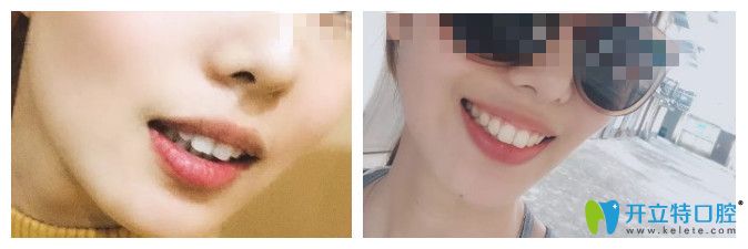 齙牙通過(guò)時(shí)代天使矯正<span style=