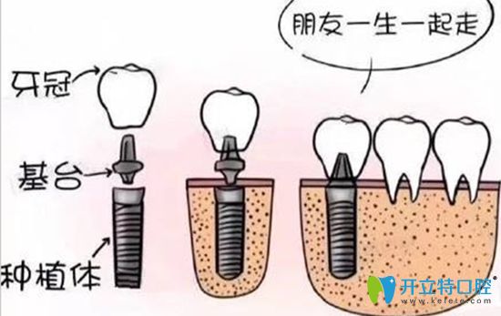 種植牙安裝基臺是不會有太大痛感