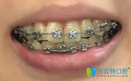 牙齒矯正3個月時的效果