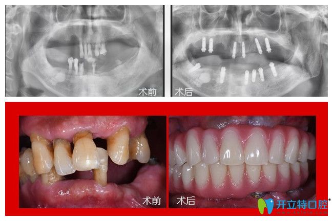 廣州廣大口腔75歲郭老在廣州廣大口腔做了全口種植牙1年多后來(lái)反饋感受