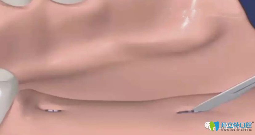 種植牙二期安裝愈合基臺(tái)疼嗎