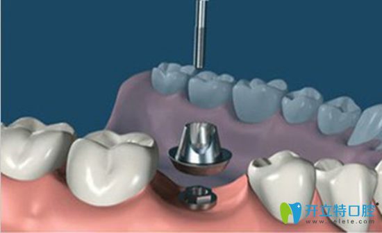 種植牙基臺是什么