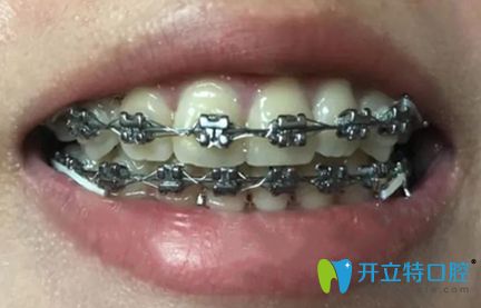 在深圳好佰年矯正牙齒9個月的效果圖