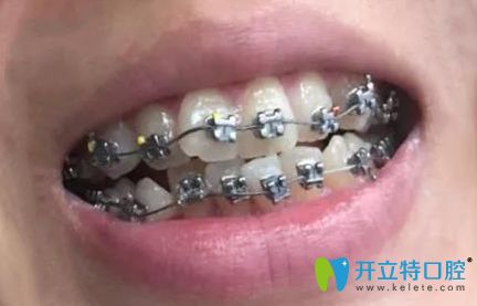 聽說深圳南山區(qū)好的牙科是好佰年口腔,正畸體驗(yàn)后來分享