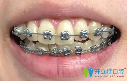 牙齒矯正半年效果圖