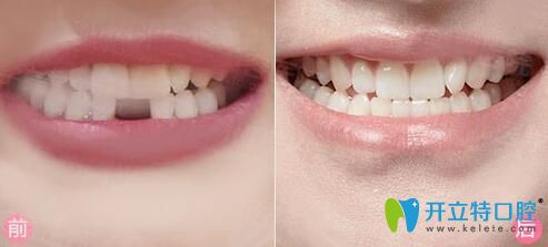 重慶牙博士口腔種植牙案例