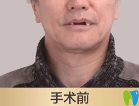 老爸在北京維樂口腔做種植牙前的照片