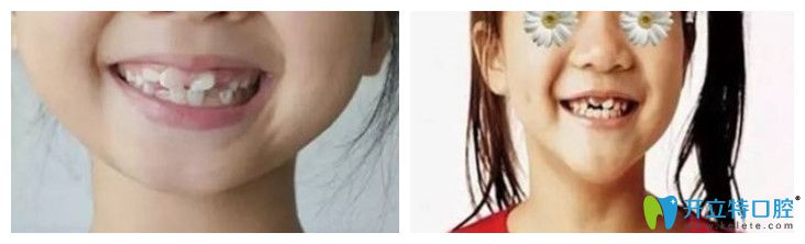 于淋醫(yī)生解答：換牙的時候舔牙牙齒會長歪，這是真的嗎？