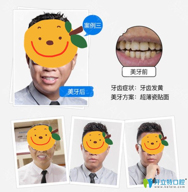 廣州瓷貼面哪家做的好？在曙光口腔做了牙貼面顧客用效果來說話