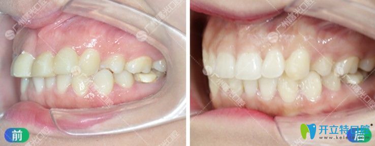 曙光口腔齙牙矯正前后對(duì)比照片