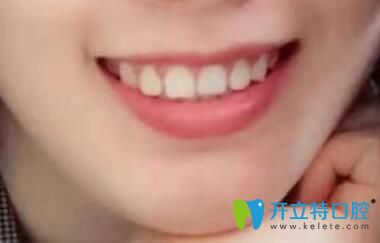 我在深圳諾德齒科做牙齒矯正1年半的效果