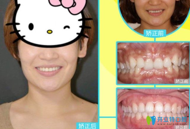 長沙中諾口腔深覆合+牙齒擁擠矯正案例