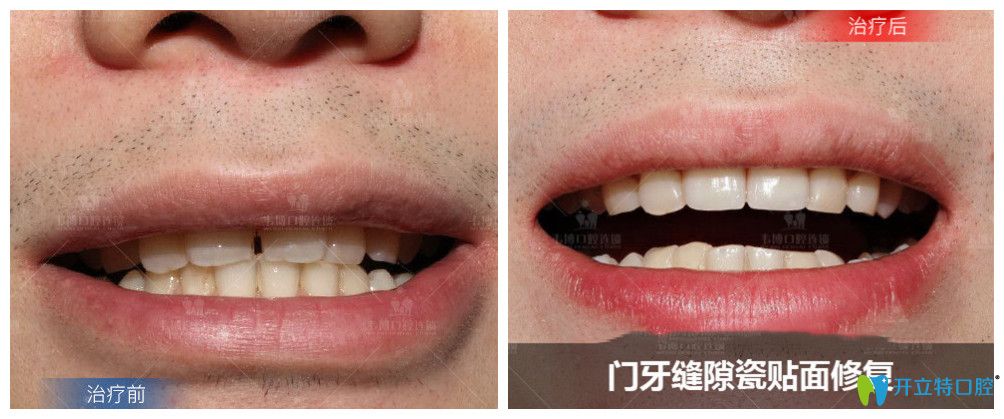 門牙縫隙大的小哥哥就做了瓷貼面修復(fù)
