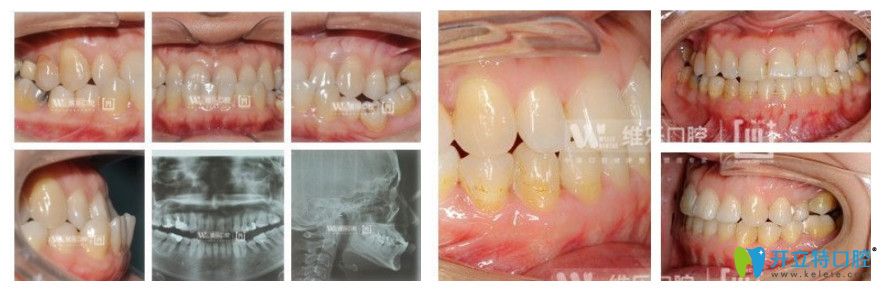 維樂口腔8歲女性地包天矯正前后對比圖