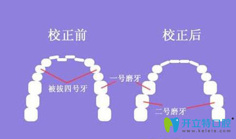 牙齒矯正的前后效果圖