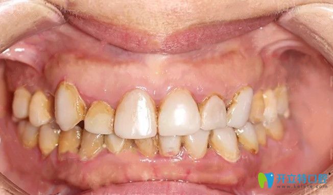 做完樹(shù)脂貼面3年后的牙齒情況